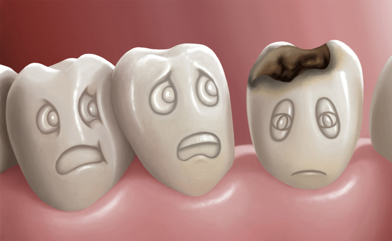 پوسیدگی دندان ها | دکتر فواد شهابیان